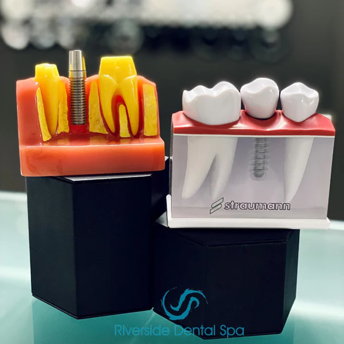 Dental Implants in London The Best Way to Replace Missing Teeth Riverside Dental Spa