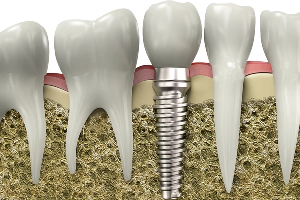 Are You A Suitable Candidate for Dental Implants?