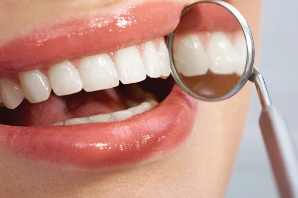 Dental Veneers: Frequently Asked Questions Answered