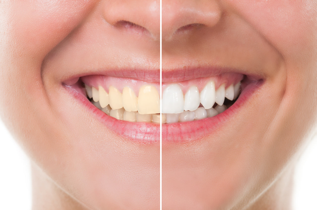 Save 50% on Zoom Teeth Whitening This Christmas