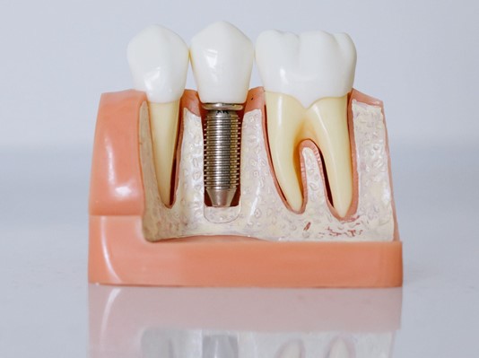 Dental implants vs veneers: which is the right treatment for you?
