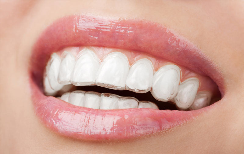 The three best types of invisible orthodontic braces – Riverside Dental Spa