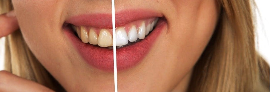 Enlighten or Zoom Whitening: Which Is Best For You?