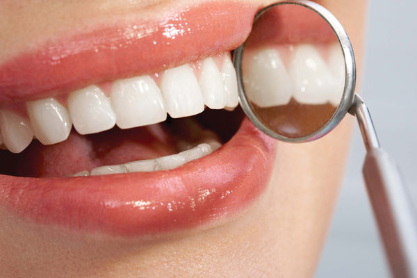 Dental Veneers