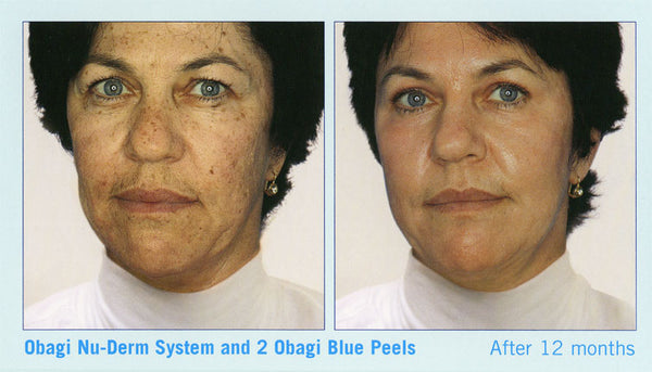 Obagi Nu-Derm® System