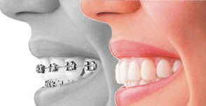 Invisible Clear braces