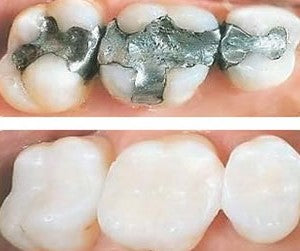 White (tooth coloured) fillings